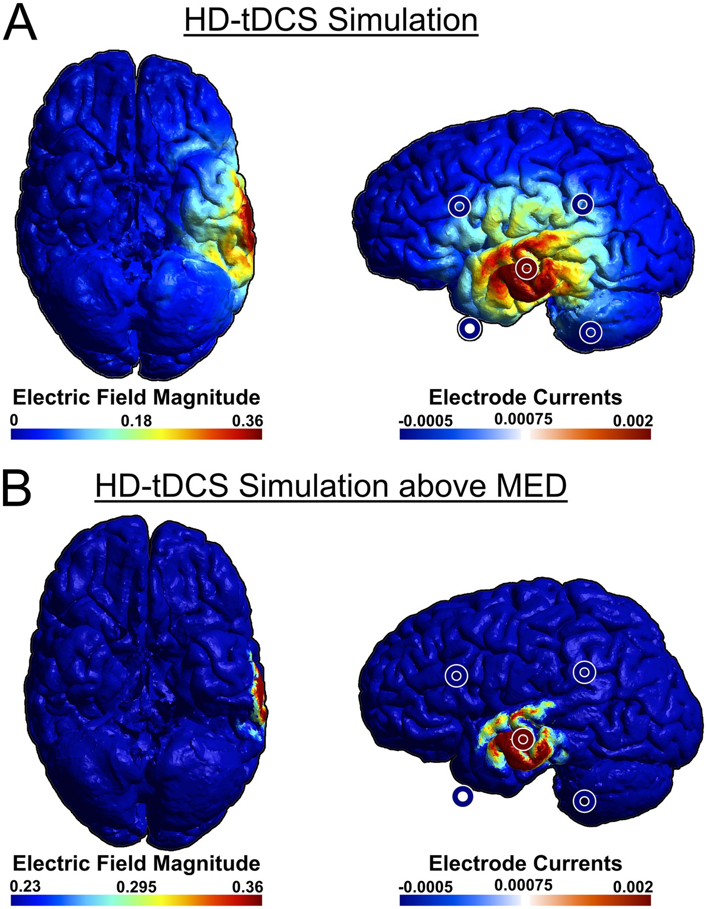 A simulation of HD-tDCS on a brain: A) The top panel shows electric field magnitude ranging from 0 to 0.36. The side view displays electrode currents with values between -0.0005 and 0.002, and the resultant stimulation centered over the middle temporal gyrus. B) The lower panel shows a similar arrangement but with a higher threshold for field magnitude, ranging from 0.23 to 0.36, showing more focal activity in the same regions.