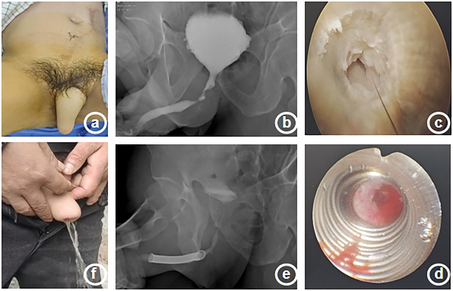 A collage of six images labeled a to f: (a) postoperative view of a lower abdomen with a surgical scar, (b) X-ray showing a filled bladder, (c) endoscopic view of a urethral channel, (d) circular object with concentric patterns, (e) X-ray showing a tubular structure connected to the bladder, (f) person urinating.