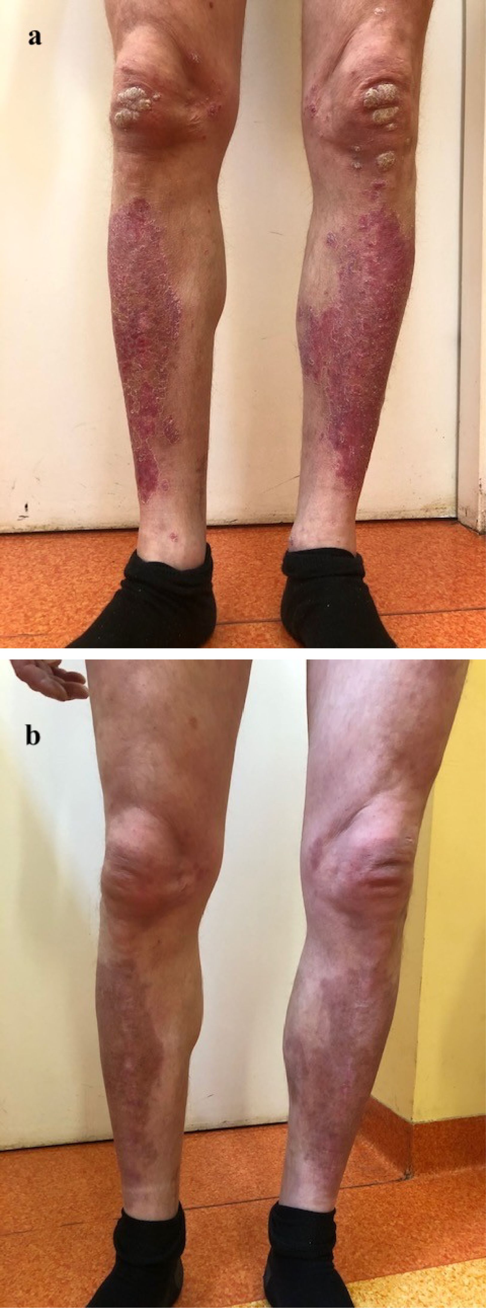 Two images showing legs with skin conditions. In the first image, labeled “a,” the legs are covered with red, scaly patches and plaques, especially on the knees and shins. In the second image, labeled “b,” the same legs are shown with significantly reduced redness and scaling, indicating improvement in the skin condition. Both images include feet in black socks.