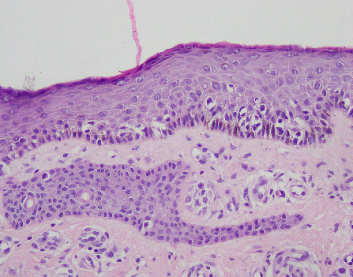 Microscopic image of skin tissue stained with hematoxylin and eosin. Purple-stained nuclei are visible within stratified squamous epithelium layers, above the pink-stained dermis. The distinct layers and cellular structures are evident.