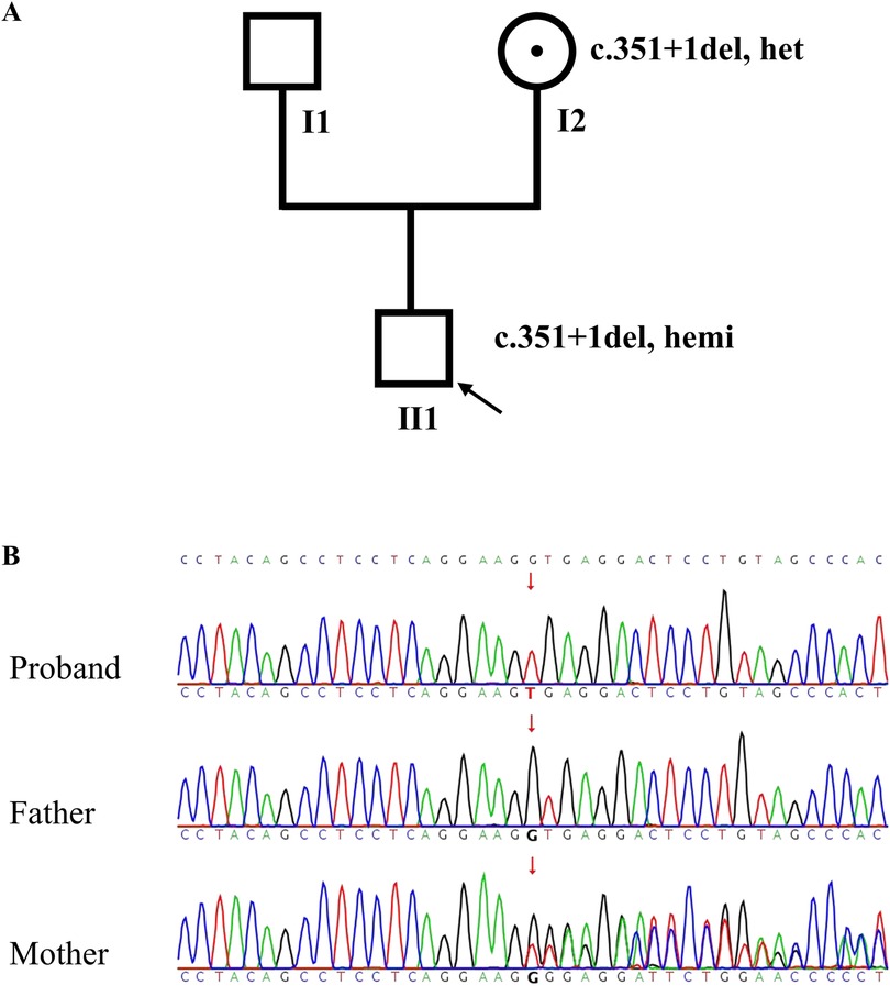 Diagram A shows a pedigree chart with individuals I1, I2, and II1. I2 is a carrier of the c.351+1del mutation, marked as heterozygous (het). II1 has the same mutation, marked as hemizygous (hemi). Diagram B displays sequencing chromatograms for the proband, father, and mother, with arrows indicating the mutation site in each sequence.