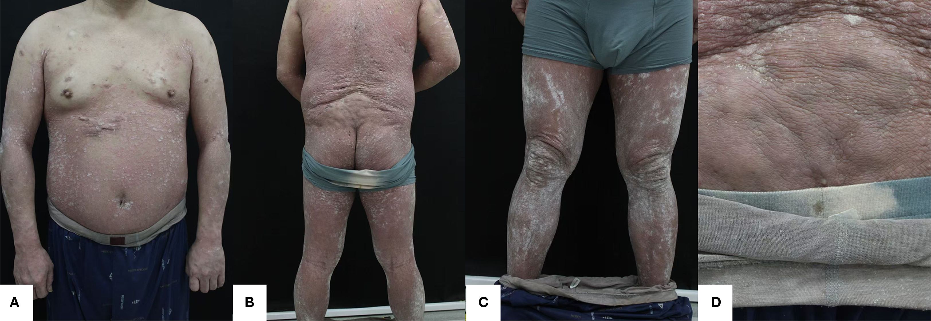 Four panels of a human body showing skin with a scaly rash. Panel A: front view of the upper body. Panel B: rear view of the body. Panel C: rear view focused on the legs. Panel D: close-up of textured skin on the lower back.