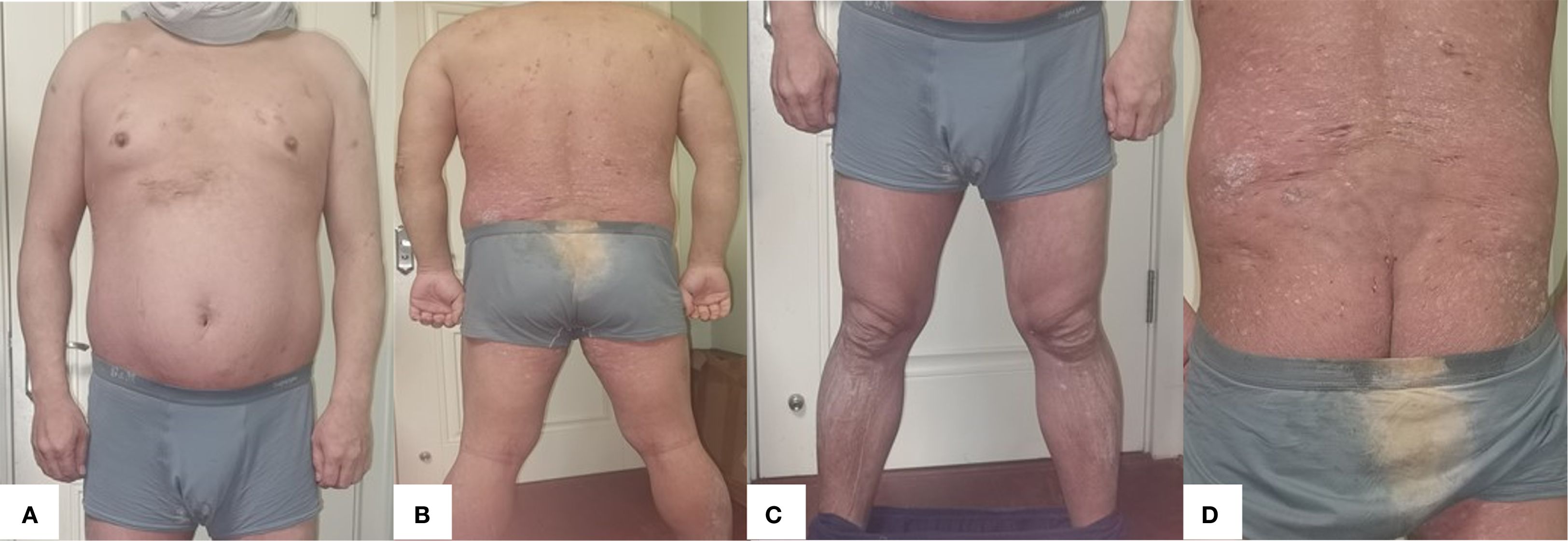 Four images labeled A to D show a person standing in underwear, with various skin conditions visible. Image A shows a front view with some skin discoloration on the chest. Image B depicts a back view revealing widespread skin irritation. Image C presents a closer view of the legs, showing dryness and scaling. Image D gives a detailed view of the lower back, emphasizing the extent of skin issues.