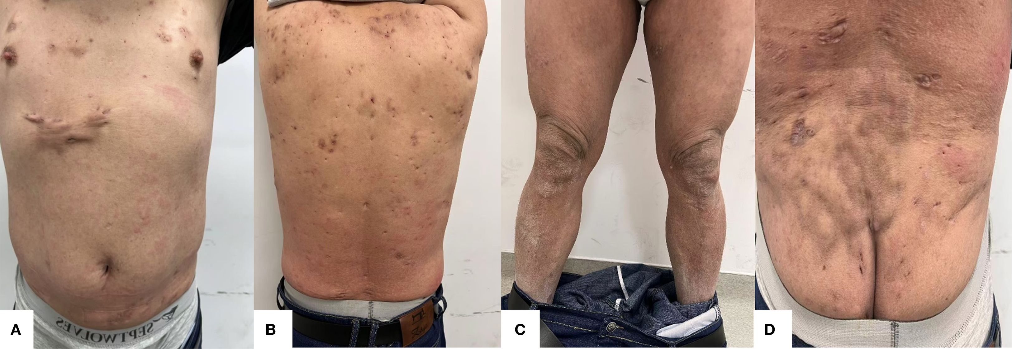 Four images showing various sections of a person's body with skin irregularities. A: Chest with visible scarring and bumps. B: Back displaying numerous small spots and marks. C: Front view of legs with dry, scaly skin near the knees. D: Lower back with visible scars and skin indentations.