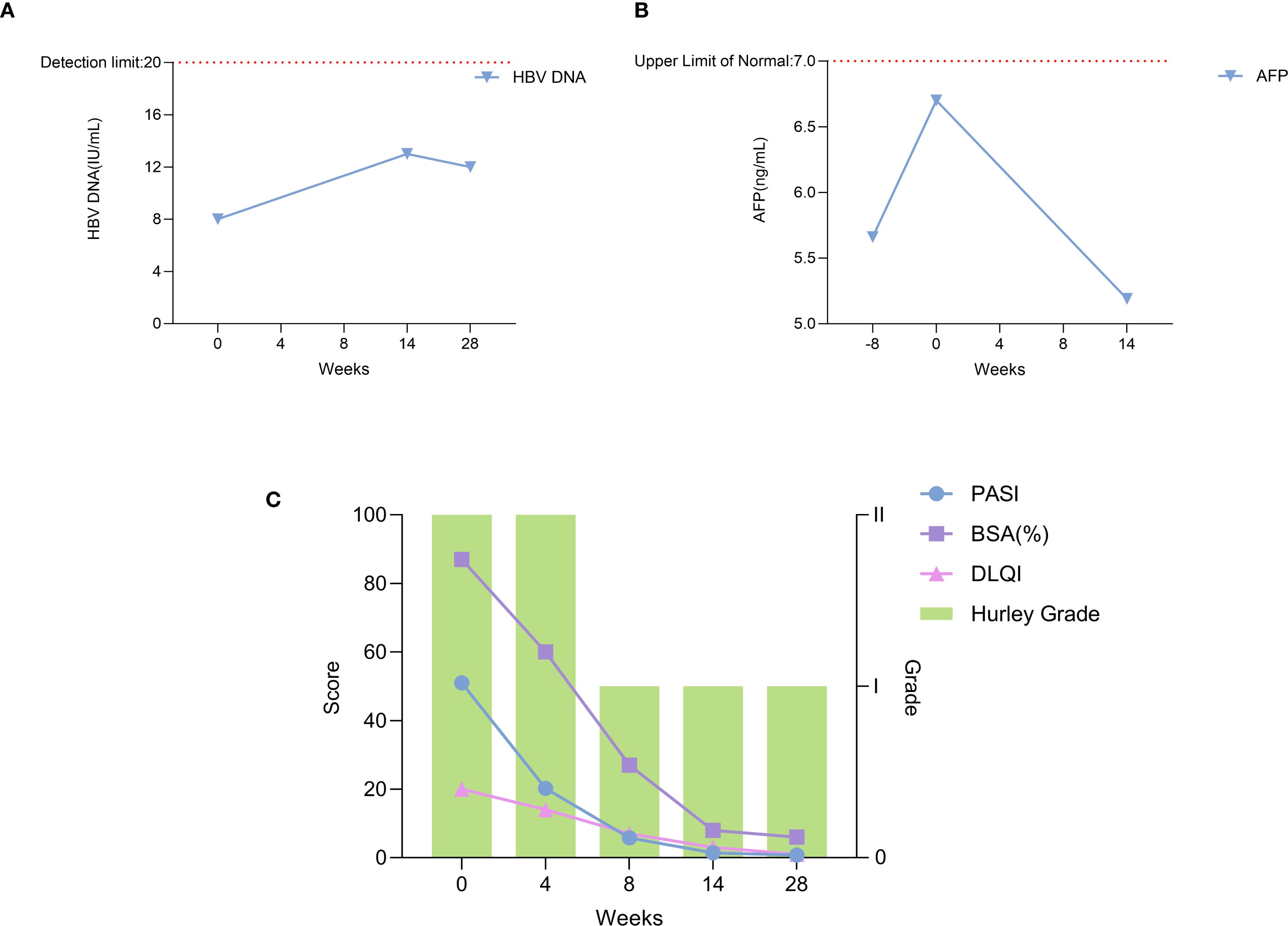 Chart A shows HBV DNA levels measured in IU per mL over 28 weeks, increasing from 8 to 14. Chart B presents AFP levels in ng per mL peaking at week 0. Chart C displays PASI, BSA, and DLQI scores decreasing over 28 weeks with Hurley Grade I and II as background.