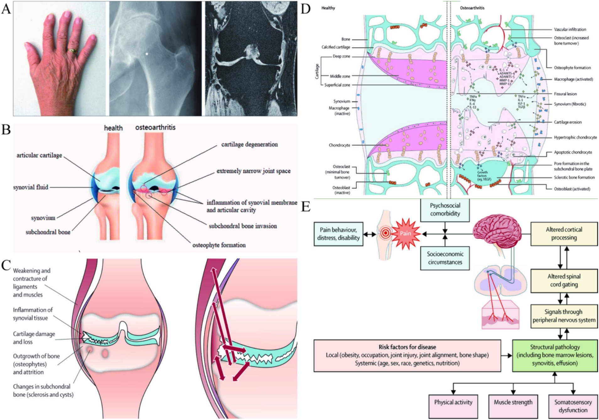 Composite image depicting aspects of osteoarthritis. Panel A shows a hand, hip X-ray, and MRI scan. Panel B illustrates the differences between healthy and osteoarthritic joints, highlighting changes like cartilage degeneration and osteophyte formation. Panel C details effects like ligament weakening and bone changes in osteoarthritis. Panel D contrasts healthy and osteoarthritic tissue microenvironments with labeled components. Panel E presents a flowchart of osteoarthritis risk factors and pathways, including pain behavior, structural pathology, and socioeconomic factors.
