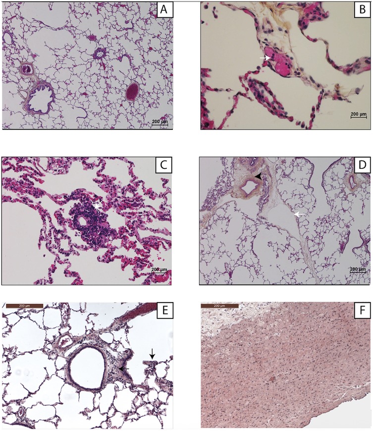 Panel A shows normal lung tissue with clear alveolar spaces. Panel B highlights a cluster of cells with prominent staining. Panel C displays dense cellular infiltration in the alveolar space. Panel D shows thickening of alveolar walls. Panel E features abnormal cell presence within alveoli. Panel F presents a homogeneous tissue texture, likely indicating a different tissue type. Scale bars indicate 200 micrometers.