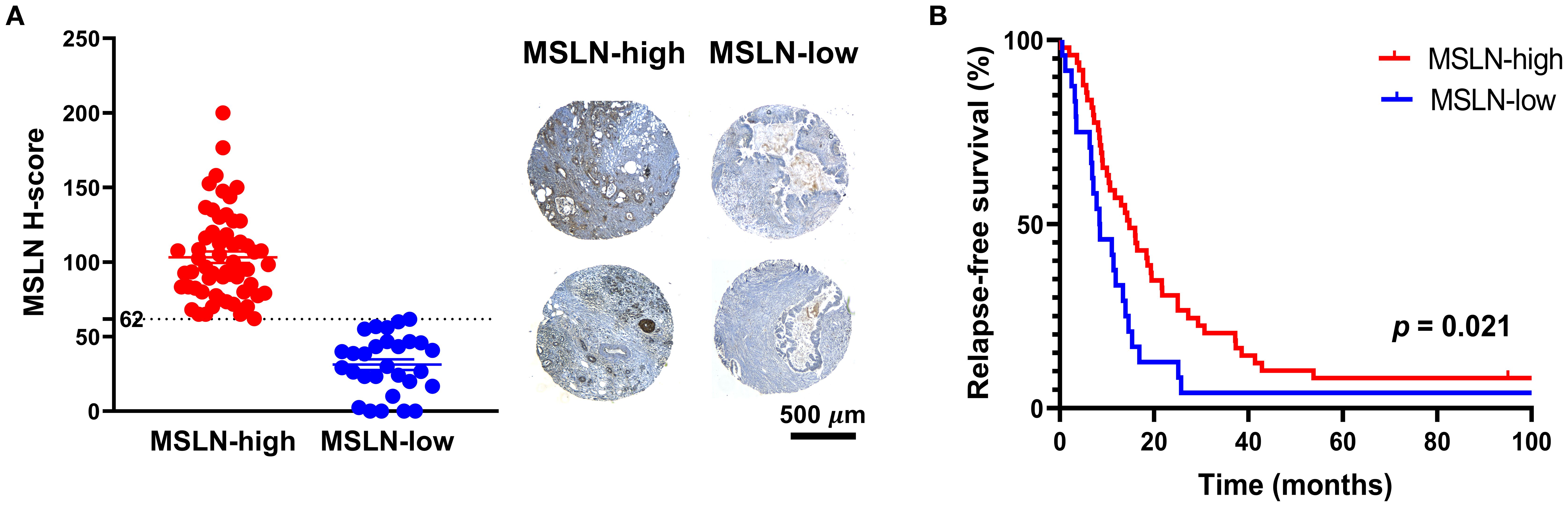 An Australian tissue microarray was profiled for MSLN expression. Panel A shows distribution of MSLN H-scores between MSLN-high (red dots) and MSLN-low (blue dots) groups, with representative tissue microarray images. Panel B shows Kaplan-Meier curves of relapse-free survival for MSLN-high (red line) and MSLN-low (blue line) groups, with a p-value of 0.021.
