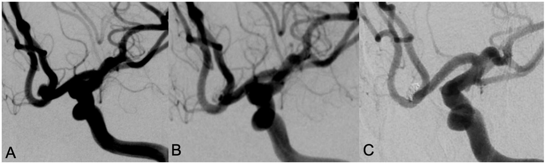 Three-panel angiographic images labeled A, B, and C show cerebral blood vessels with a focus on an aneurysm. Panel A illustrates a prominent bulge in the artery. Panel B shows progress or change in the aneurysm structure. Panel C highlights a reduced or absent aneurysm, indicating an intervention or healing.