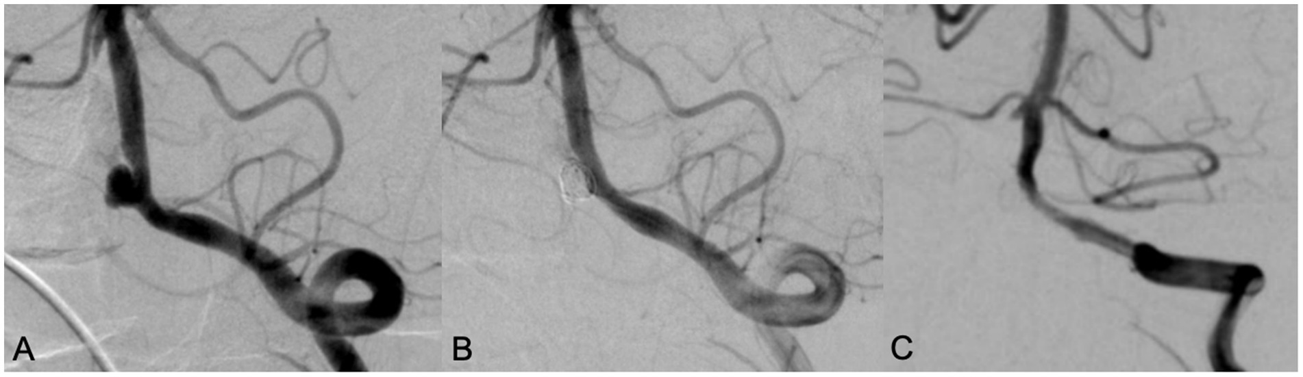 Three angiographic images labeled A, B, and C show a cerebral artery with varying conditions. Image A displays an artery with a bulge indicating an aneurysm. Image B shows the placement of a coiling device within the aneurysm. Image C depicts the artery post-treatment with reduced bulge and improved flow.