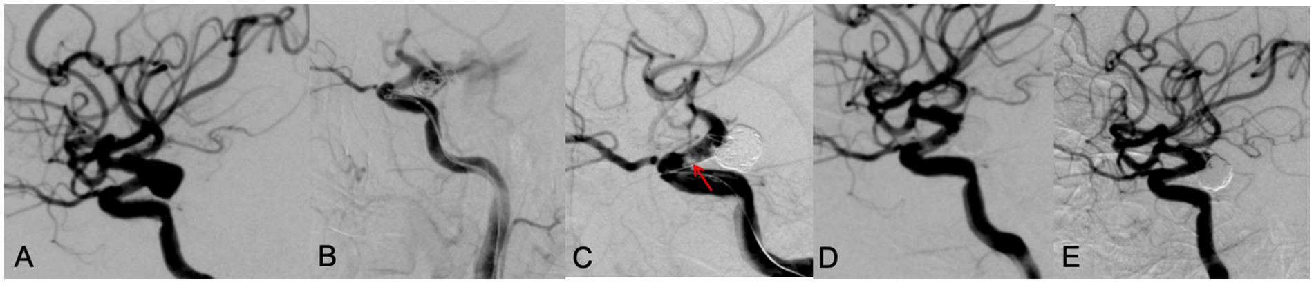 Angiographic sequence labeled A to E. A shows a cerebral aneurysm with coiled mass. B displays the vessel without intervention. C highlights a surgical tool with a red arrow pointing to the aneurysm site. D shows partial coil placement. E shows post-procedure with completed coiling.