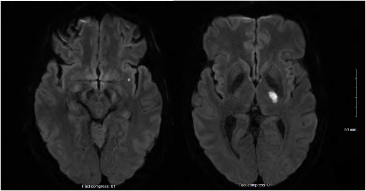 MRI scans of a brain in axial view, showing two images side by side. The left image shows a standard brain scan, while the right image highlights a bright area, indicating a lesion or abnormality.