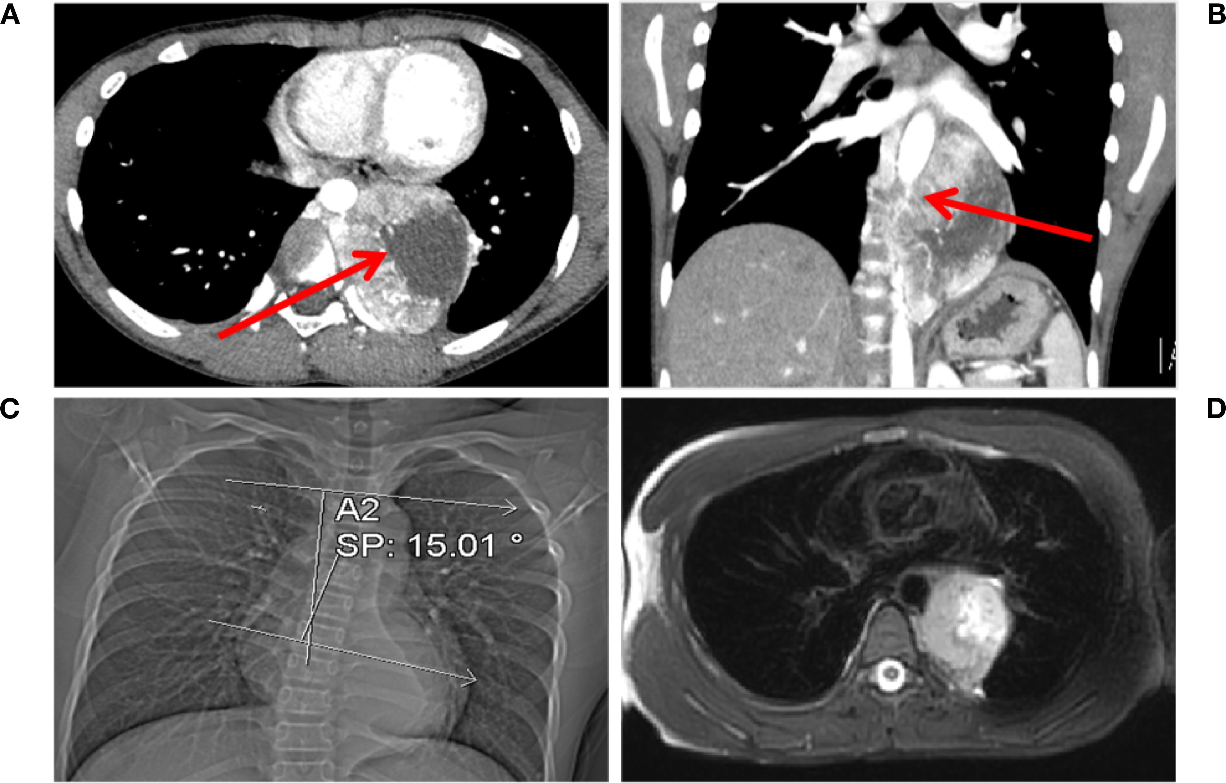 CT and MRI scans of the chest show abnormal growths. Image A and B highlight a mass with red arrows in axial and coronal views. Image C is a chest X-ray with angular measurement marked as A2 SP: 15.01 degrees. Image D presents a cross-sectional MRI view of the chest.