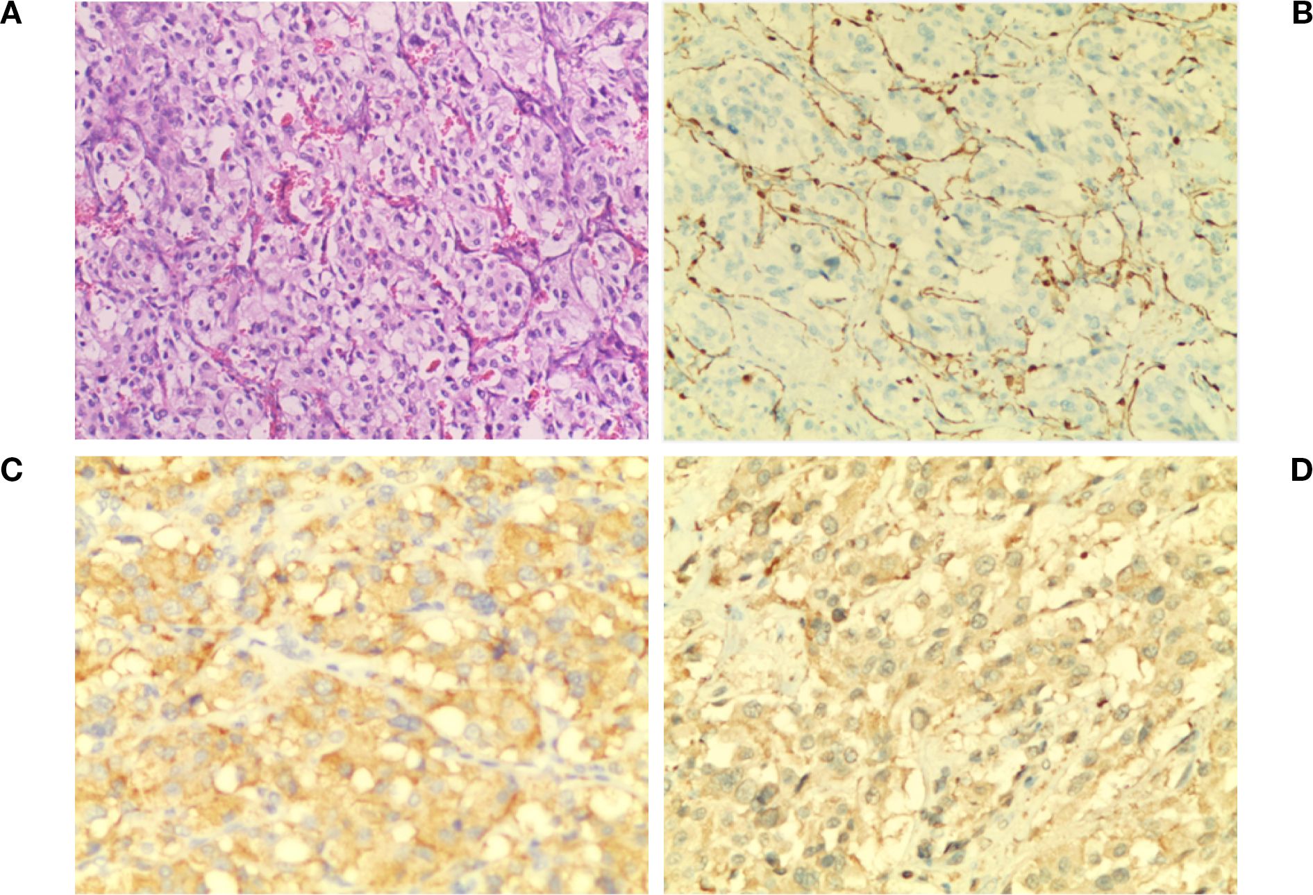 Four-panel composite image showing different histological sections of small cell carcinoma of the prostate. Panel A shows a hematoxylin and eosin stain with clusters of small, densely packed cells. Panel B illustrates CD34 immunostaining highlighting blood vessels. Panel C depicts CK7 staining with cytoplasmic positivity. Panel D presents CK20 staining with weak or negligible expression.