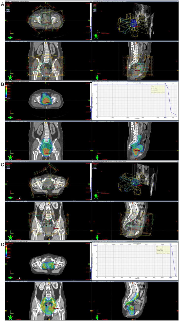 Medical imaging screenshots show cross-sectional views labeled A, B, C, and D. Each contains CT scans of pelvis and abdomen with colored dose distributions, along with anatomical outlines and 3-D visualizations of radiation beams. Graphs adjacent to B and D show dose-volume histograms with corresponding data curves.
