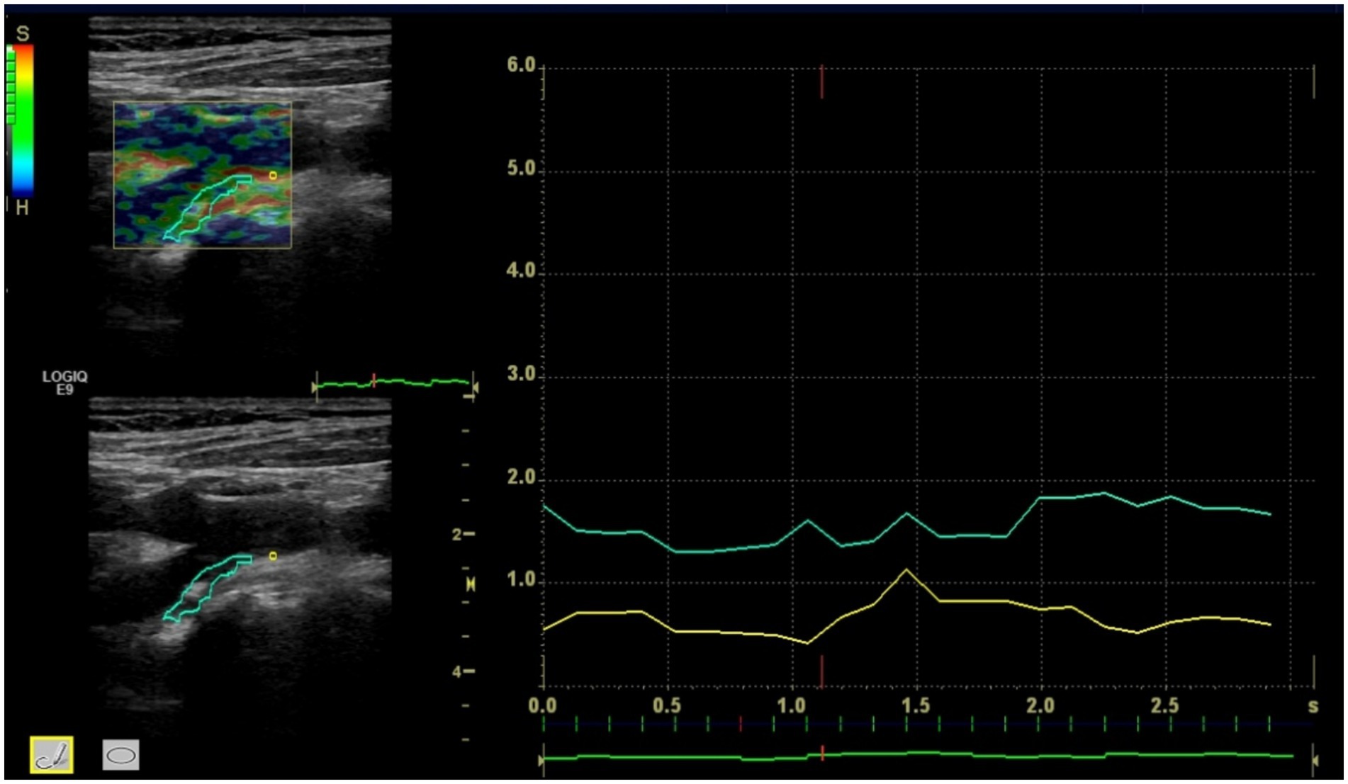 Ultrasound image displaying a color-coded elastography on the left, showing different tissue stiffness levels. On the right, a graph shows two line plots, in aqua and yellow, over a 3.0-second interval, indicating measured data variations. The color scale ranges from blue to red.