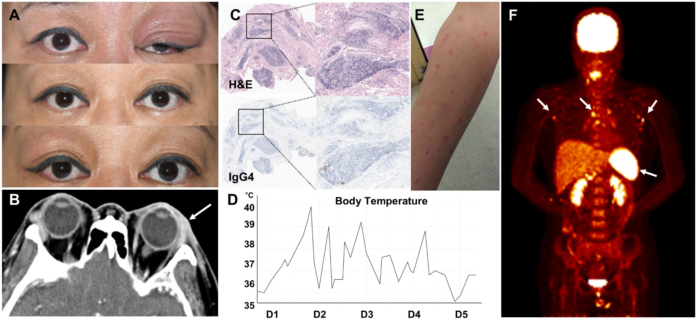 Panel A shows photographs of a person's eye, initially swollen, progressing to normal over time. Panel B displays a CT scan highlighting an orbital area. Panel C shows histological images with H&E and IgG4 staining. Panel D is a line graph tracking body temperature over five days, showing fluctuating temperatures. Panel E depicts an arm with a rash. Panel F is a PET scan image with highlighted areas indicating inflammation or abnormal activity.