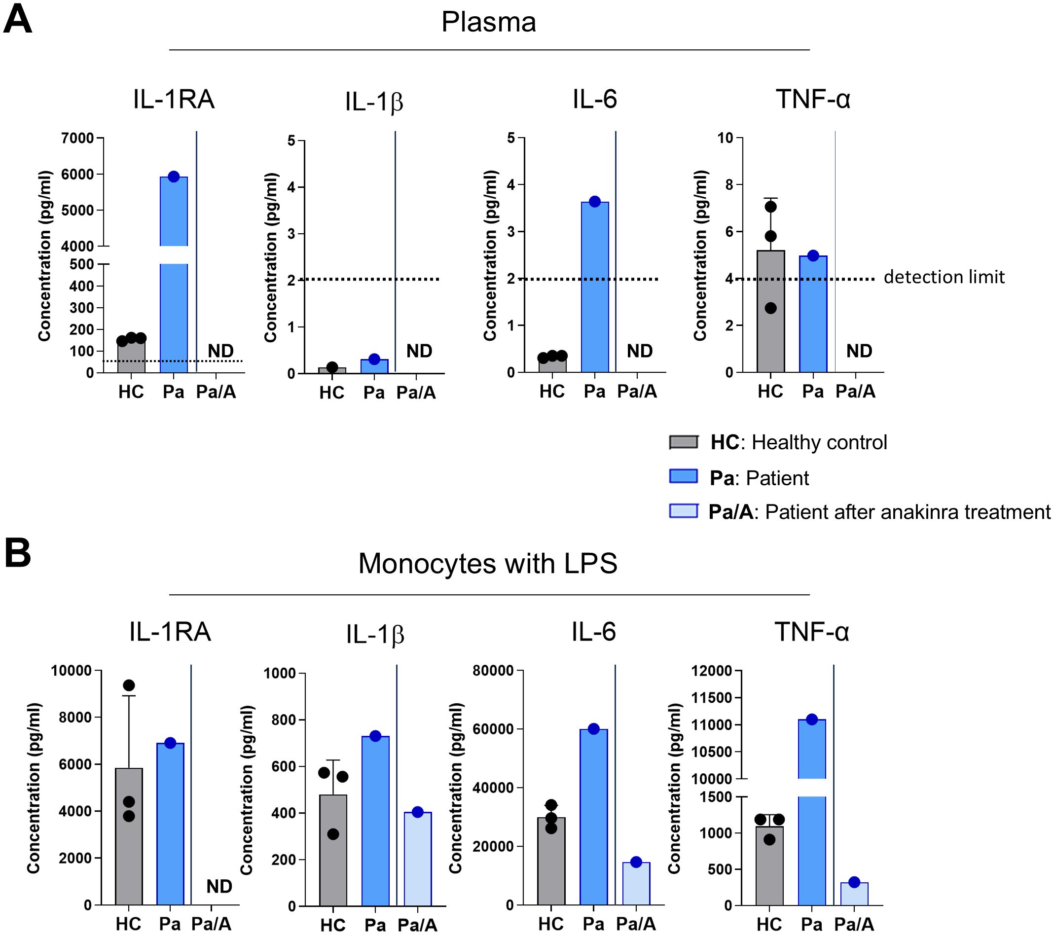 Bar graphs showing cytokine concentrations in plasma (Panel A) and monocytes with LPS (Panel B) for three groups: Healthy Control (HC), Patient (Pa), and Patient after Anakinra Treatment (Pa/A). Concentrations of IL-1RA, IL-1β, IL-6, and TNF-α are compared, with a notable decrease observed in patients after anakinra treatment. ND indicates a non-detectable value.