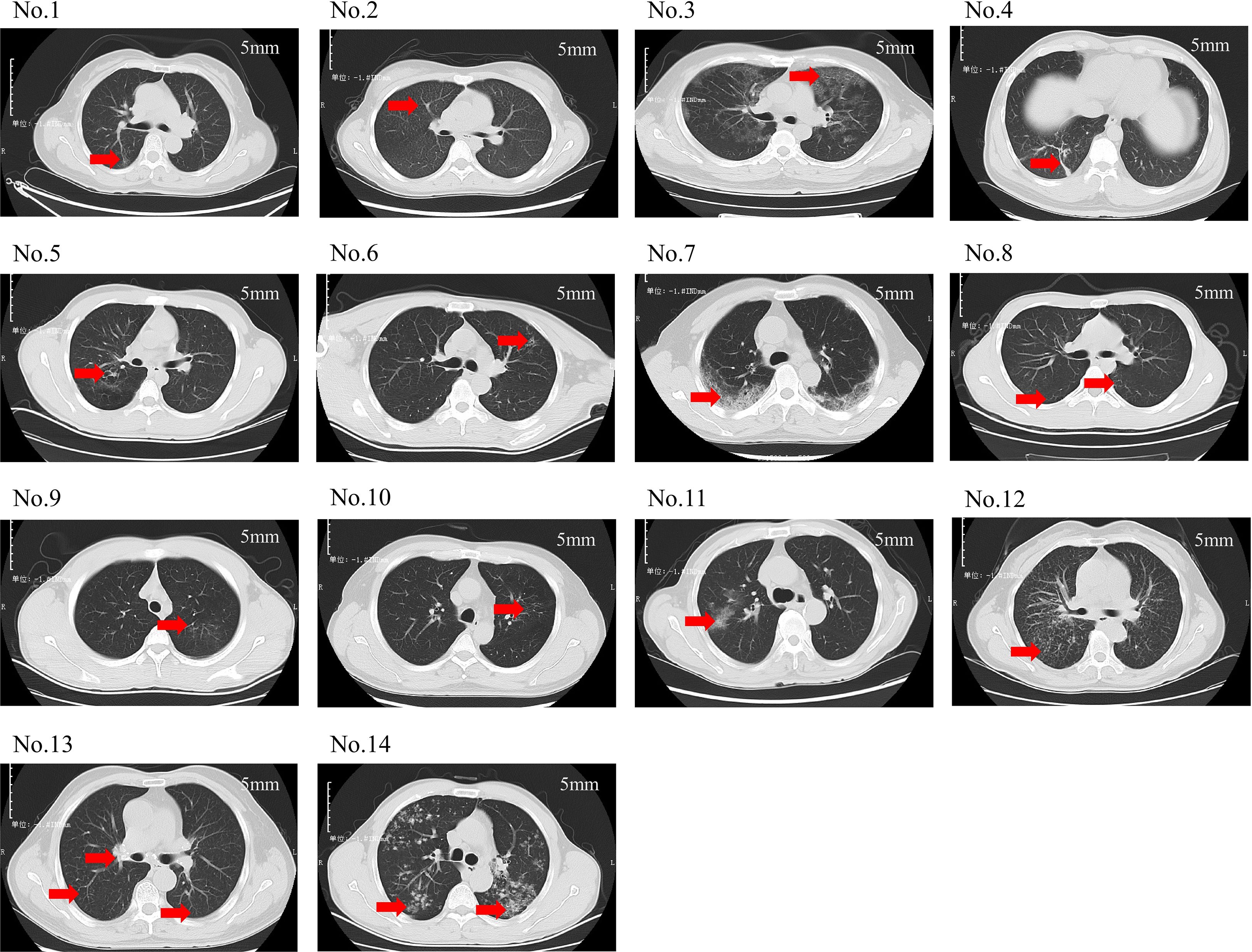 CT scan images of lungs labeled No.1 to No.14, each marked with a red arrow indicating areas of interest. The scans display variations in lung tissue density and patterns, each captured at a slice thickness of 5 mm.