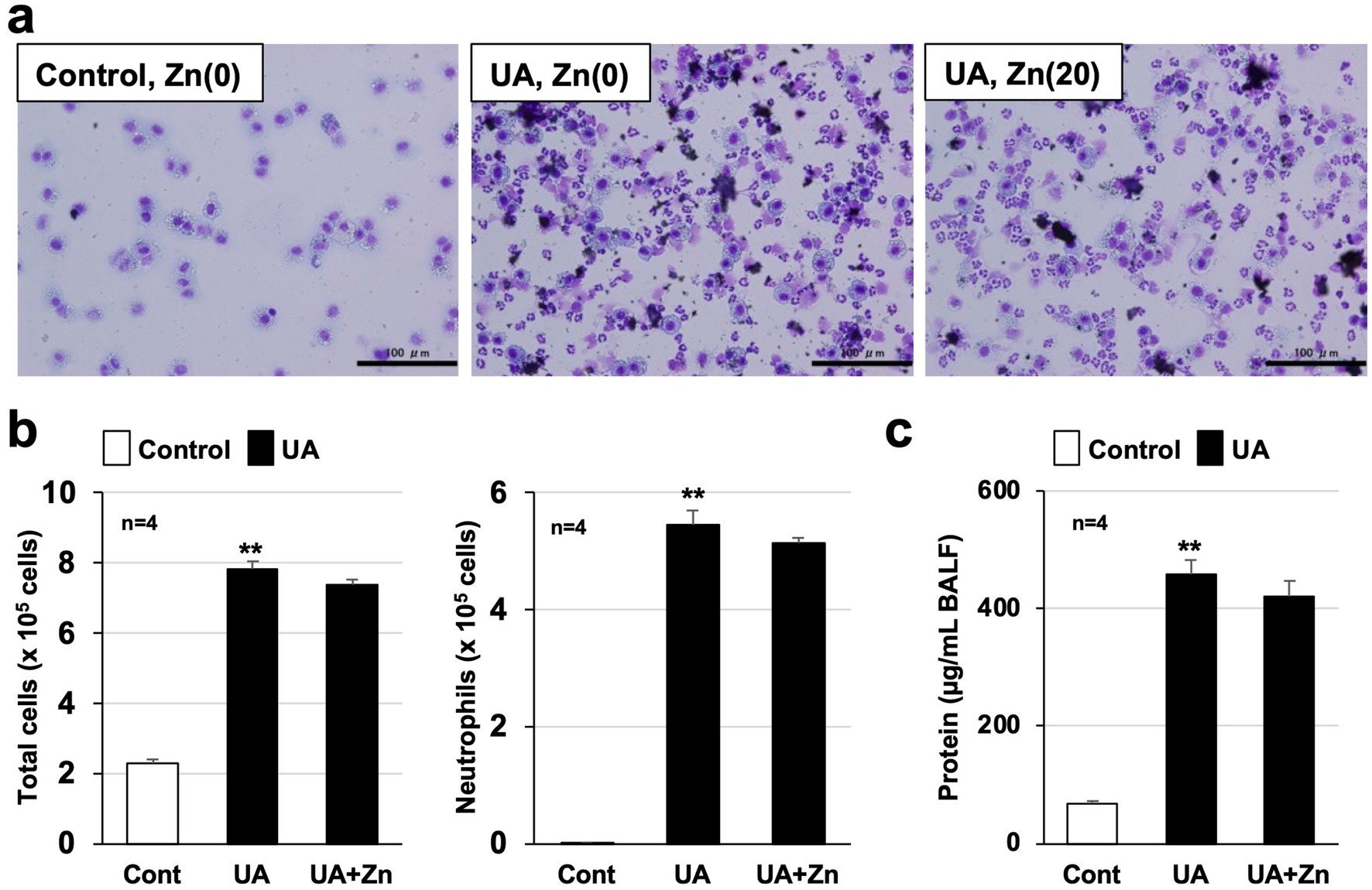 Panel a shows images of cells under three conditions: Control with Zn(0), UA with Zn(0), and UA with Zn(20), displaying the number and type of BALF cells. Panel b presents bar graphs comparing the number of total cells and neutrophils under Control, UA, and UA with Zn, indicating an increase in both under UA conditions. Panel c shows a bar graph of protein concentration in BALF for the same conditions, with significant increases under UA. Statistical significance is noted with asterisks.