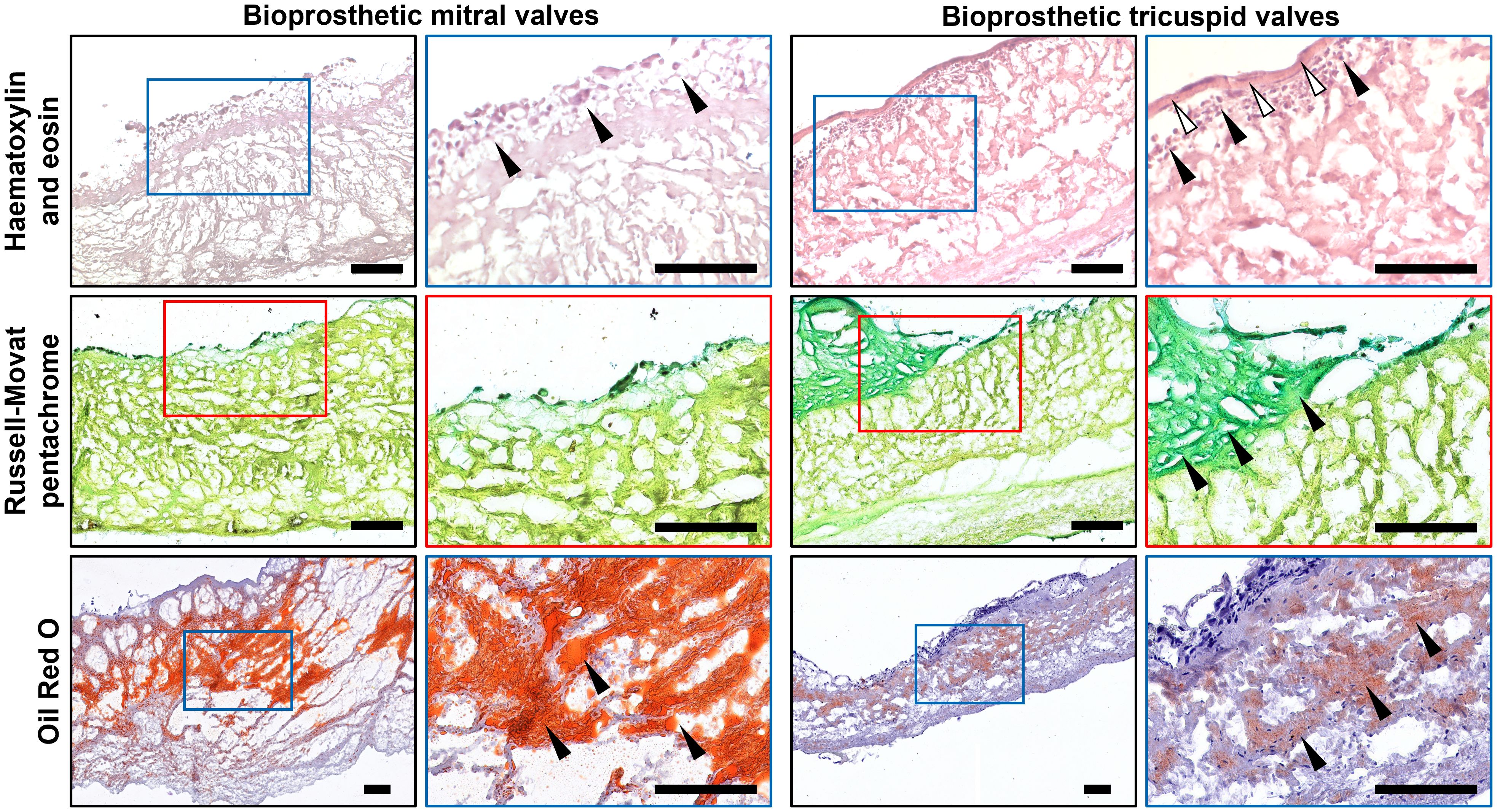 Histological images comparing bioprosthetic mitral and tricuspid valves using different staining techniques. The top row shows hematoxylin and eosin stains with host cells (indicated by black arrows) at and beneath the inflow or outflow side (white arrows indicate the pannus). Russell-Movat’s pentachrome staining (middle) shows collagen (yellow color) but not glycosaminoglycans (green color) in the bioprosthetic leaflet, also showing abundant lycosaminoglycans (green color) within the pannus (indicated by black arrows). Oil Red O staining (bottom) detected predominance of lipid droplets, fatty spots, and fatty streaks (indicated by black arrows) mostly in the spongiosa layer in mitral valves.