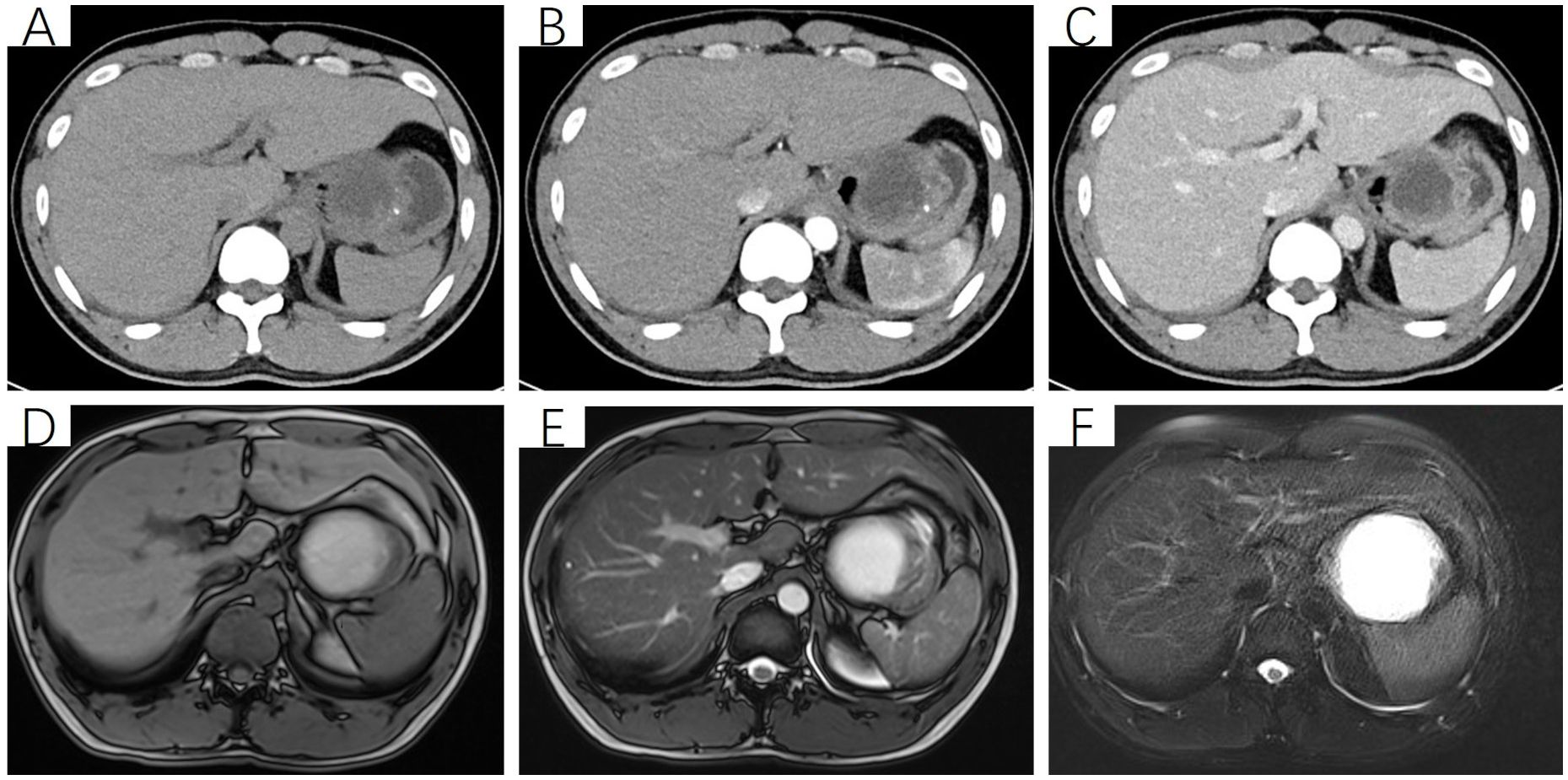 CT and MRI images of abdominal scans labeled A to F. A, B, and C are CT images showing variations in tissue density. D, E, and F are MRI images highlighting different contrast variations, with a prominent bright area likely indicating a lesion or mass.