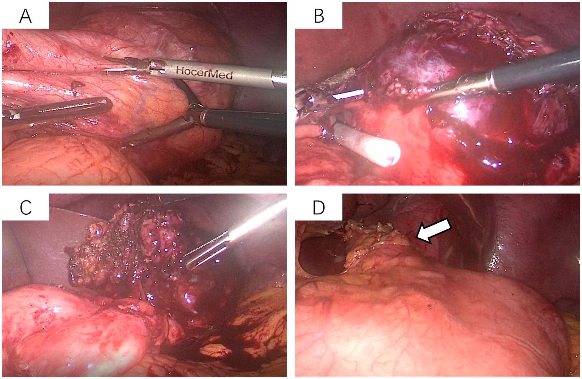 Laparoscopic images showing stages of a surgical procedure. Image A shows instruments working on tissue. Image B highlights tissue manipulation with a lighted tool. Image C depicts removal of affected tissue. Image D reveals a lesion marked by an arrow on the tissue surface.