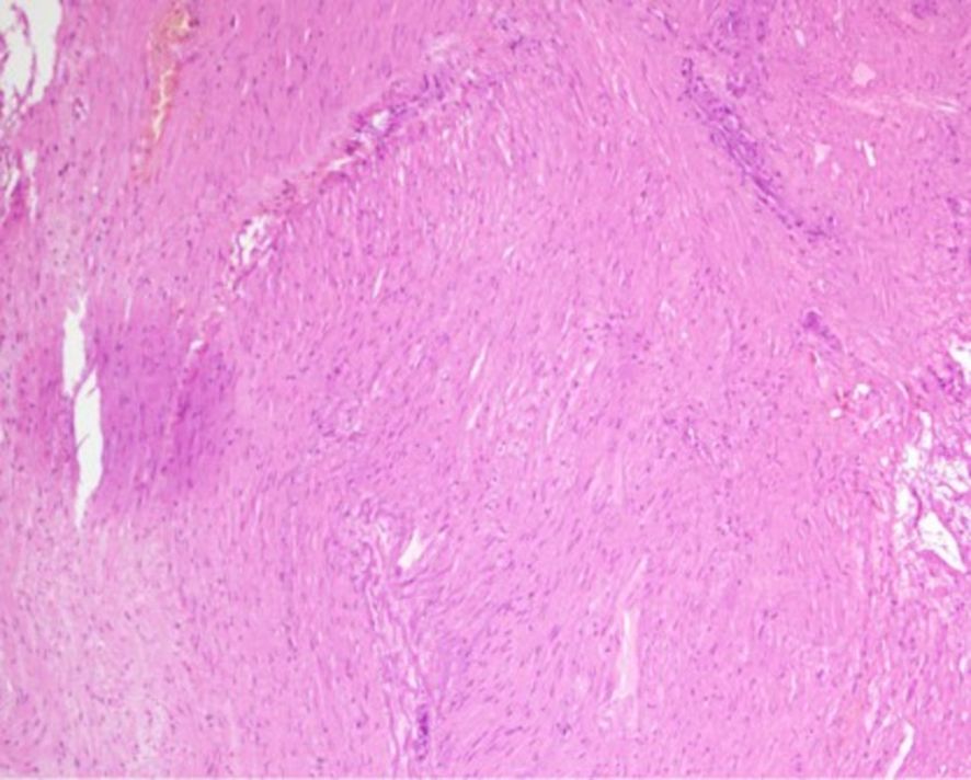 Microscopic view of tissue stained pink and purple, indicating a fibrous texture with densely packed cells and elongated nuclei. The image features varying shades of pink and purple, suggesting differences in tissue density and structure.