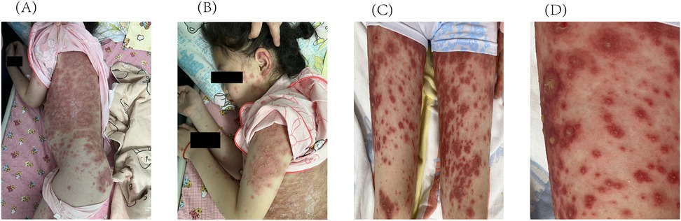(A) A person's back showing widespread red lesions and scaling. (B) A side view of a young person with similar lesions on the face, arm, and back. (C) Both legs displaying dense red lesions with inflamed appearance. (D) Close-up of a leg with detailed view of red lesions, some with raised surfaces.