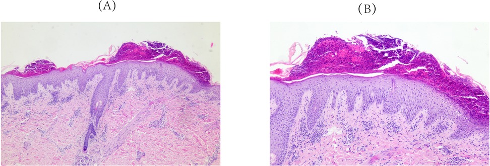 Histological images showing two sections of skin tissue labeled as A and B. Both sections display layers of epidermis and dermis with purple-stained nuclei and pink-stained connective tissue. Section A appears more densely packed with cellular structures, while Section B shows a slightly thicker epidermal layer with prominent dark purple staining on the surface, likely indicating increased cellular activity or inflammation.