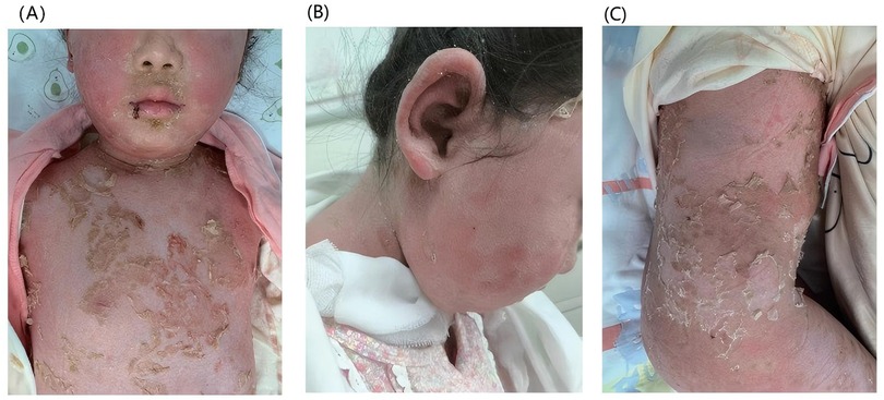 Panel A shows a child's chest with severe skin peeling and redness. Panel B displays a close-up of the side of the child's face and ear, exhibiting similar skin peeling. Panel C illustrates the child's arm, also affected by extensive peeling and redness.