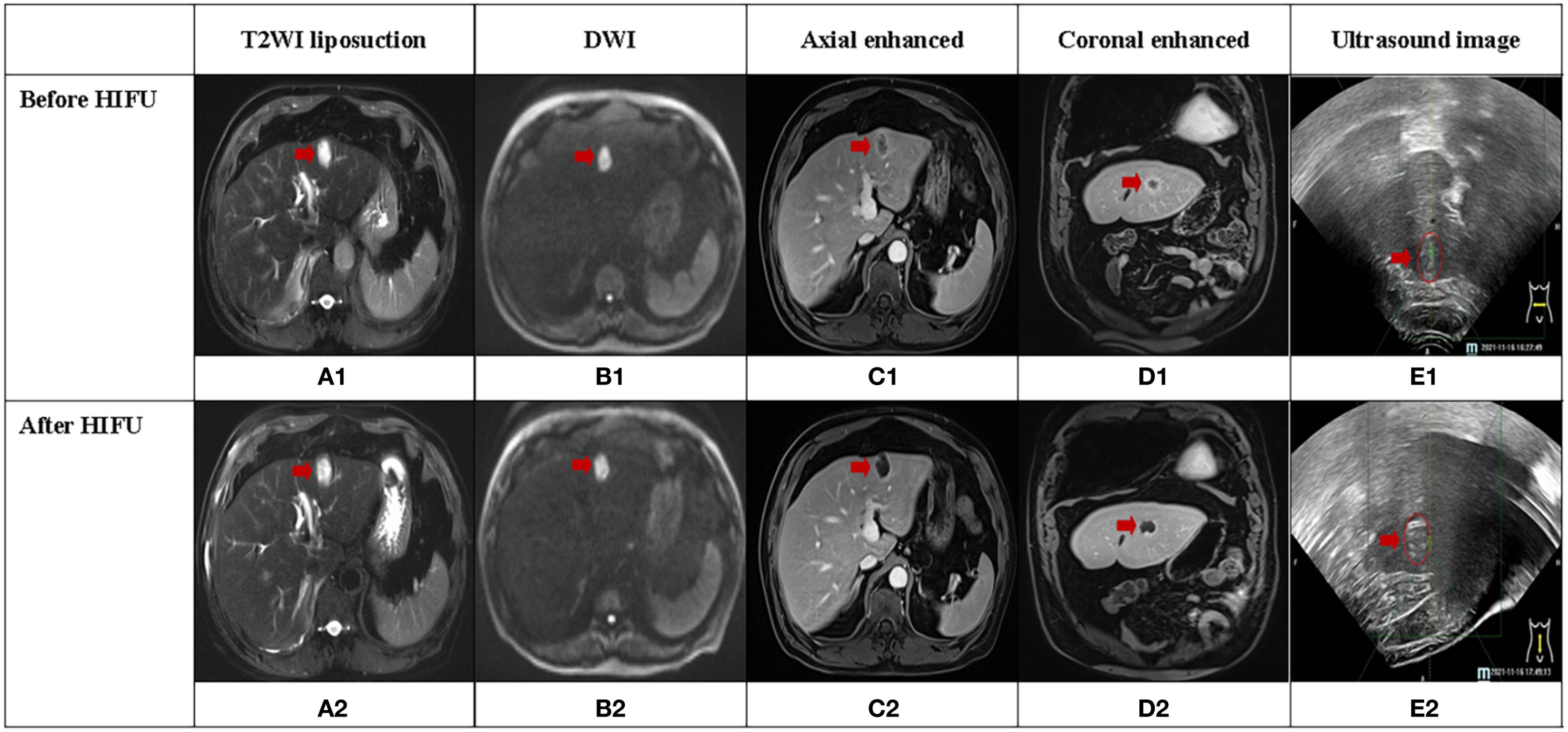 MRI and ultrasound images before and after HIFU treatment. The top row, labeled “Before HIFU,” includes T2WI liposuction (A1), DWI (B1), Axial enhanced (C1), Coronal enhanced (D1), and Ultrasound image (E1). Each shows a marked area with a red arrow. The bottom row, “After HIFU,” presents similar sequences (A2, B2, C2, D2, E2) with changes observed post-treatment.