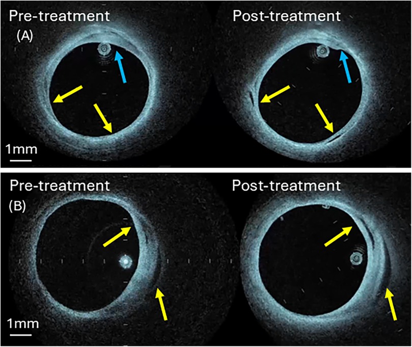 Two pairs of circular cross-sectional scans labeled as pre-treatment and post-treatment. Panel A shows two images with blue and yellow arrows indicating specific regions. Panel B has two images with yellow arrows highlighting changes. Scale bars measure one millimeter. The images appear to be medical scans, possibly showing changes in a tubular structure before and after treatment.
