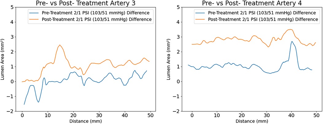 Two line graphs compare pre-treatment and post-treatment lumen area in arteries three and four over a 50-millimeter distance. The y-axis indicates lumen area in square millimeters, ranging from negative two to five. The x-axis represents distance in millimeters. The blue line shows pre-treatment data, and the orange line shows post-treatment data. In both graphs, post-treatment lines generally have larger lumen areas than pre-treatment lines. Each graph includes a legend indicating a pressure of two over one PSI or one hundred three over fifty-one millimeters of mercury difference.