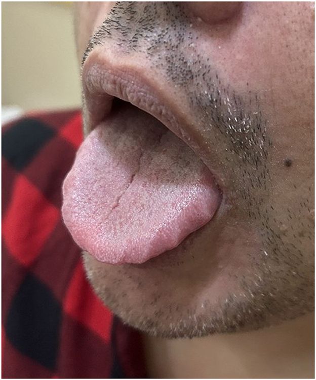 A close-up of the left side of a man's face, sticking out his tongue with a scalloped edge.