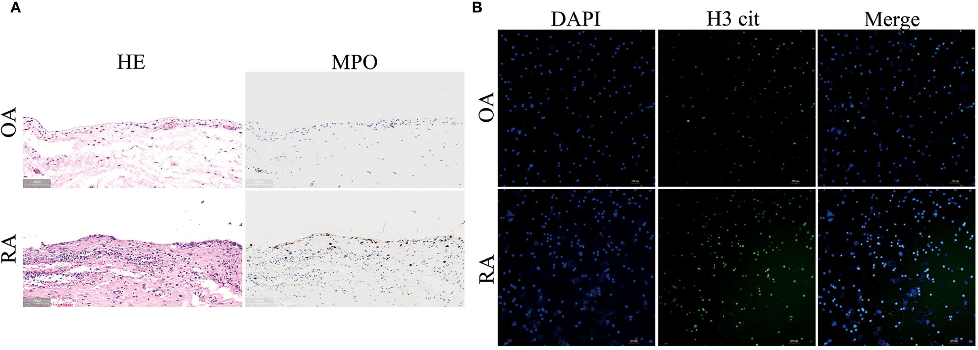 Two panels compare osteoarthritis (OA) and rheumatoid arthritis (RA) tissues. Panel A shows OA and RA histological sections with Hematoxylin & Eosin (HE) and Myeloperoxidase (MPO) staining. Panel B presents immunofluorescence images for DAPI, H3 citrulline, and merged channels, highlighting differences in cell morphology and protein expression.