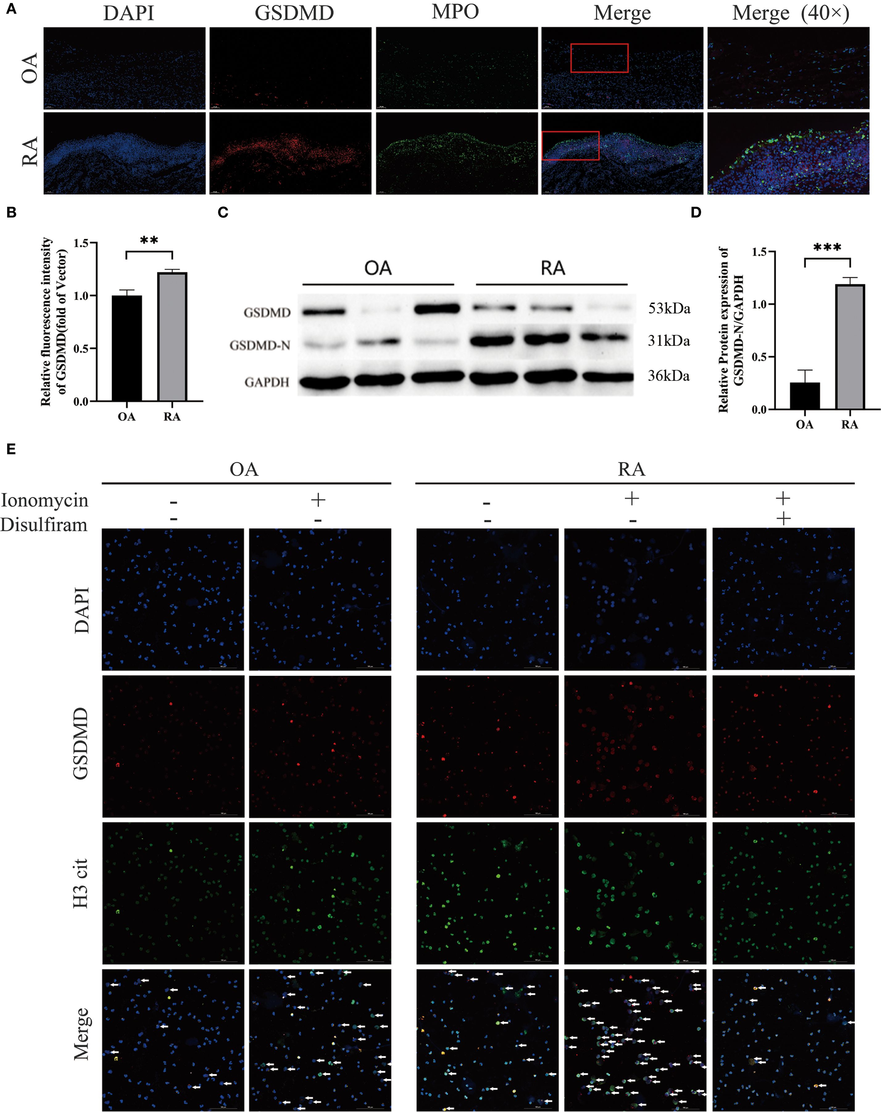 (A) Immunofluorescence images showing DAPI, GSDMD, and MPO staining in OA and RA tissues with merged images and a magnified view at forty times. (B) Bar graph comparing the relative fluorescence intensity of GSDMD in OA and RA, showing a significant increase in RA. (C) Western blot analysis displaying GSDMD and GSDMD-N levels with GAPDH as a control in OA and RA tissues. (D) Bar graph showing relative protein expression of GSDMD-N, significantly higher in RA. (E) Immunofluorescence images of OA and RA cells treated with ionomycin or disulfiram, showing DAPI, GSDMD, and H3 cit staining with merged views.