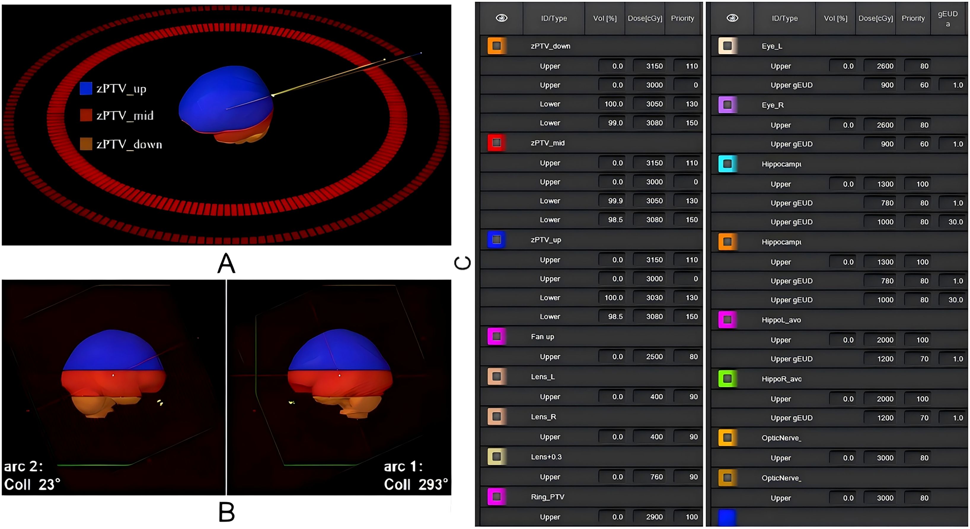 Medical imaging graphic displaying three regions: zPTV_up (blue), zPTV_mid (red), and zPTV_down (orange). Panels A and B show 3D views with angles labeled. Adjacent table lists treatment parameters and doses for each region.
