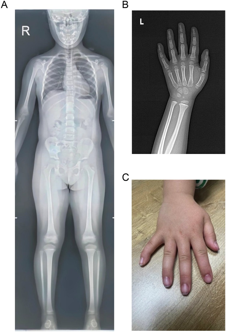 X-ray and clinical images showcasing skeletal and hand structure. Panel A shows a full-body X-ray from the front. Panel B depicts an X-ray of the left hand and wrist. Panel C is a photograph of a child's left hand on a wood surface.