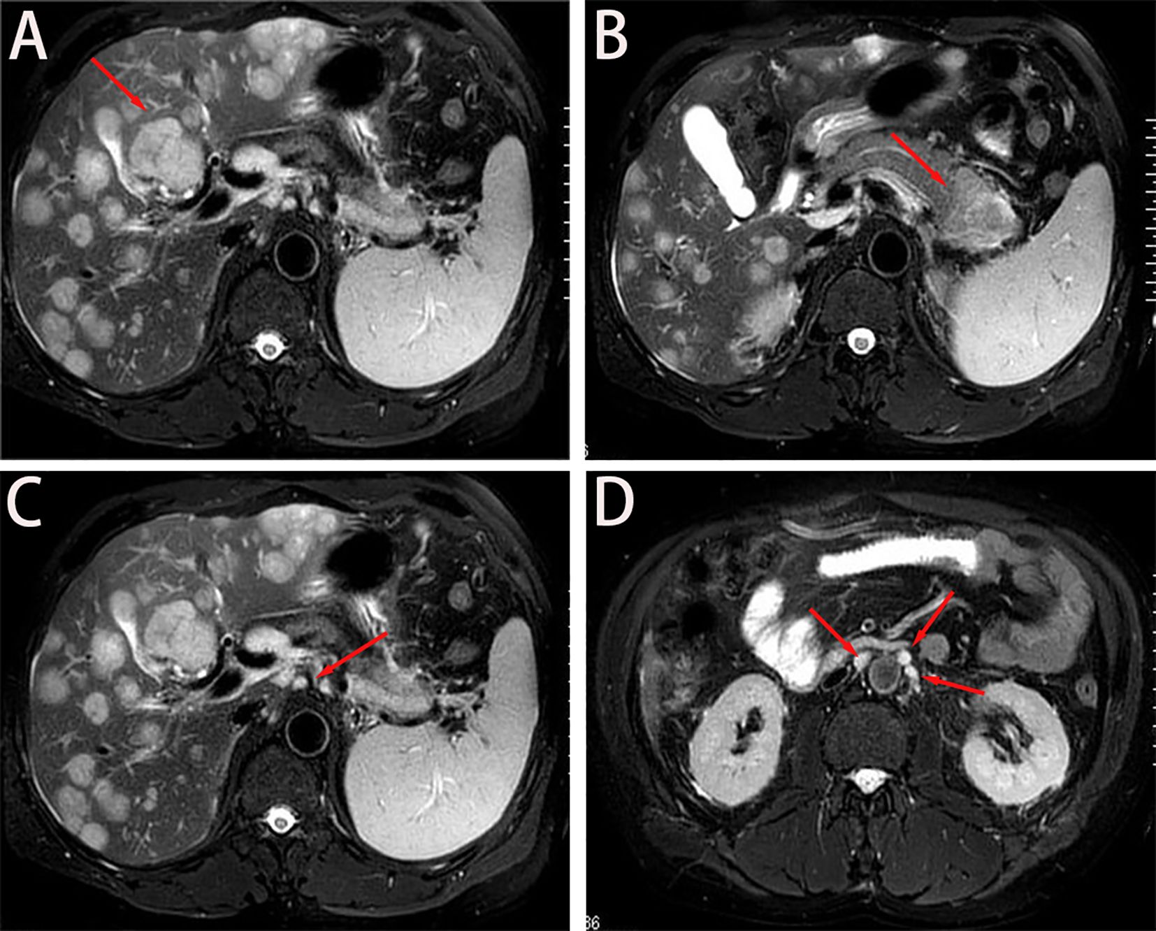 Four-panel MRI images labeled A, B, C, and D show different cross-sectional views of the abdomen. Red arrows highlight specific areas in each image. Image A shows a lesion near the liver. Image B highlights a structure near the pancreas. Image C points to the bile duct area. Image D illustrates multiple areas near the kidneys.