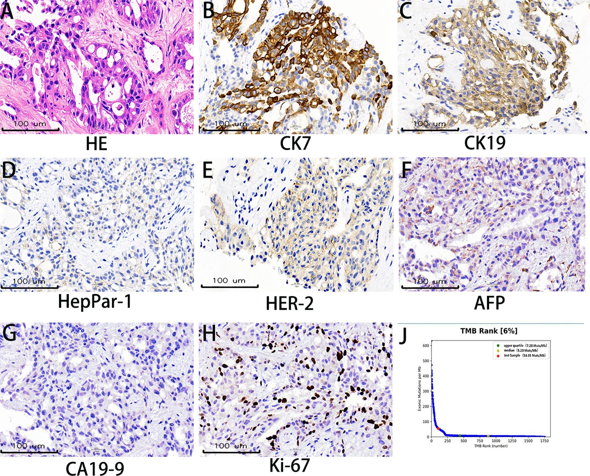 Histological image set with eight stained tissue samples labeled A to H: A shows HE stain; B, CK7; C, CK19; D, HepPar-1; E, HER-2; F, AFP; G, CA19-9; H, Ki-67, highlighting different cellular components. Panel J displays a TMB rank graph with colored indicators for quartile information. Scale bars are visible in each panel.