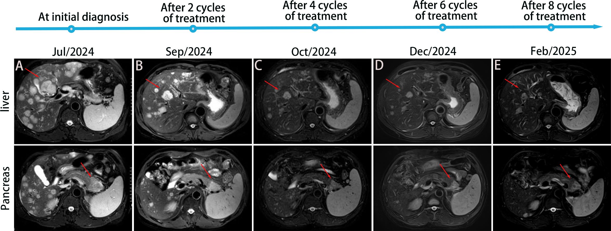 MRI scans showing liver and pancreas from July 2024 to February 2025. Each row illustrates changes after two, four, six, and eight cycles of treatment. Red arrows indicate areas of interest.