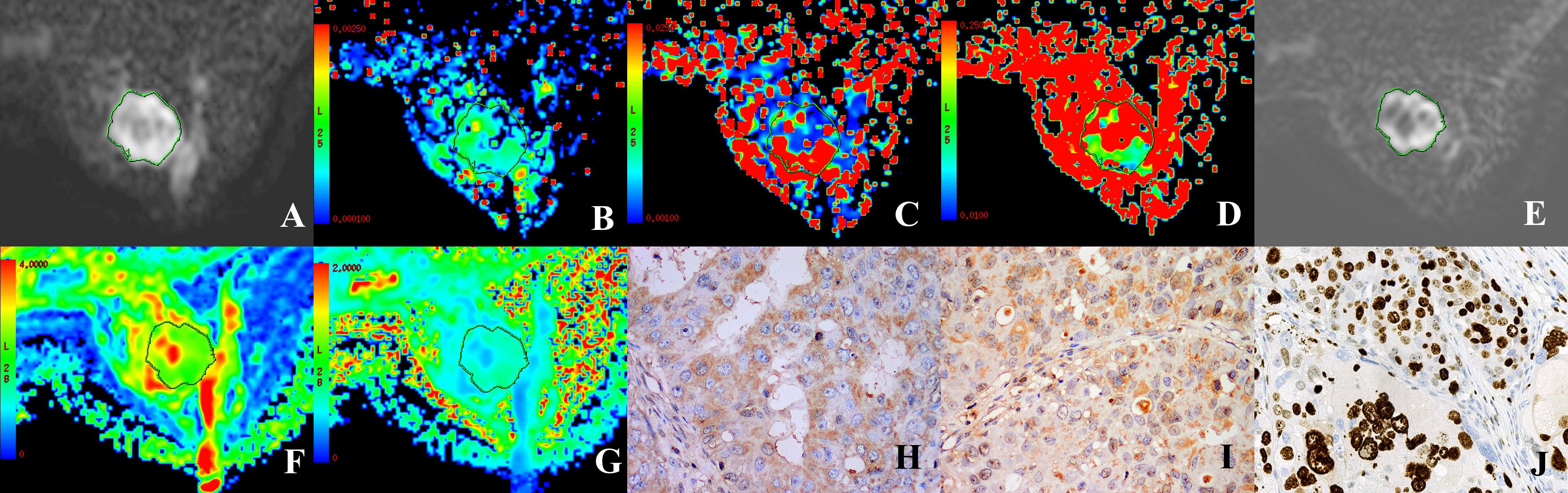 Medical image collage with ten panels labeled A to J. Panels A, E show grayscale MRI scans with highlighted regions. Panels B, C, D, F, G display color-coded heatmaps with varied intensity levels, indicating different measurements around a marked spot. Panels H, I, J, have microscopic views of tissue samples, showing cells stained in brown and blue, highlighting cellular structures. Color gradients and annotations are present in some images for measurement reference.