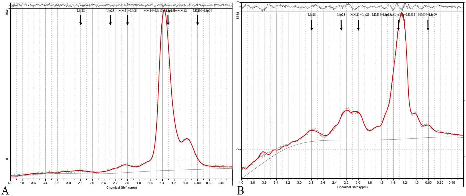 Two graphs A and B display chemical shift spectra in parts per million (ppm). Both graphs have peaks labeled with various lipid and metabolite combinations such as Lip28, Lip23, MM21, and MM09. Graph A shows a pronounced peak around 1.4 ppm, while graph B exhibits a more complex pattern with multiple peaks, including a notable one also around 1.4 ppm. Both graphs have a baseline and annotations indicating specific points of interest with arrows.