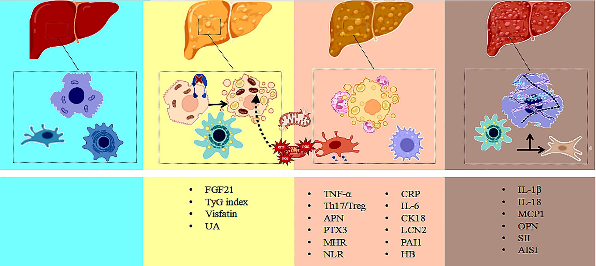 Illustration of liver conditions across four stages, each shown with detailed cellular structures, interactions, and associated inflammation markers. The background sections are color-coded. The stages are accompanied by lists of biomarkers, including FGF21, TNF-α, and IL-1β, among others, indicating various biochemical processes and inflammatory responses. Diagrams highlight changes in cell morphology and activities like ROS production and immune cell interactions.