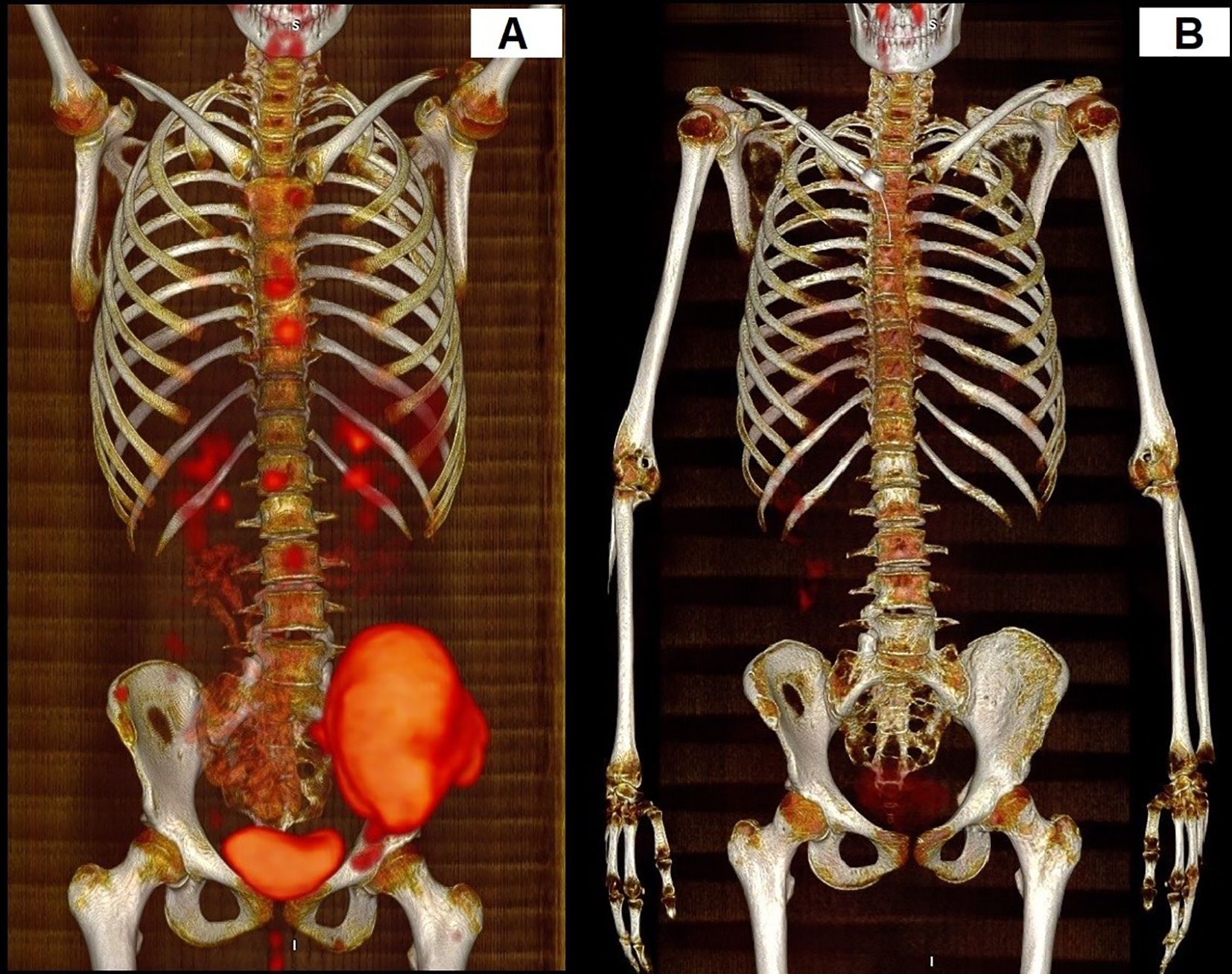 CT scan images of a human skeleton. Panel A shows areas highlighted in red, especially in the spine, ribs, pelvis, and joints, indicating potential abnormalities or areas of interest. Panel B depicts a clearer, frontal view of the skeletal structure without the red highlights, showing bones, joints, and the ribcage.