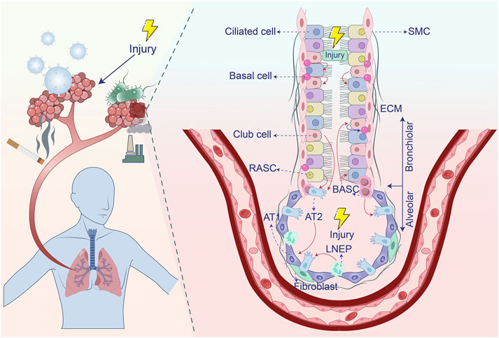 Illustration of lung injury due to factors like smoking and pollution, with a detailed cross-section of airway cells. It labels structures like ciliated cells, basal cells, and alveoli, highlighting the injury with lightning symbols.