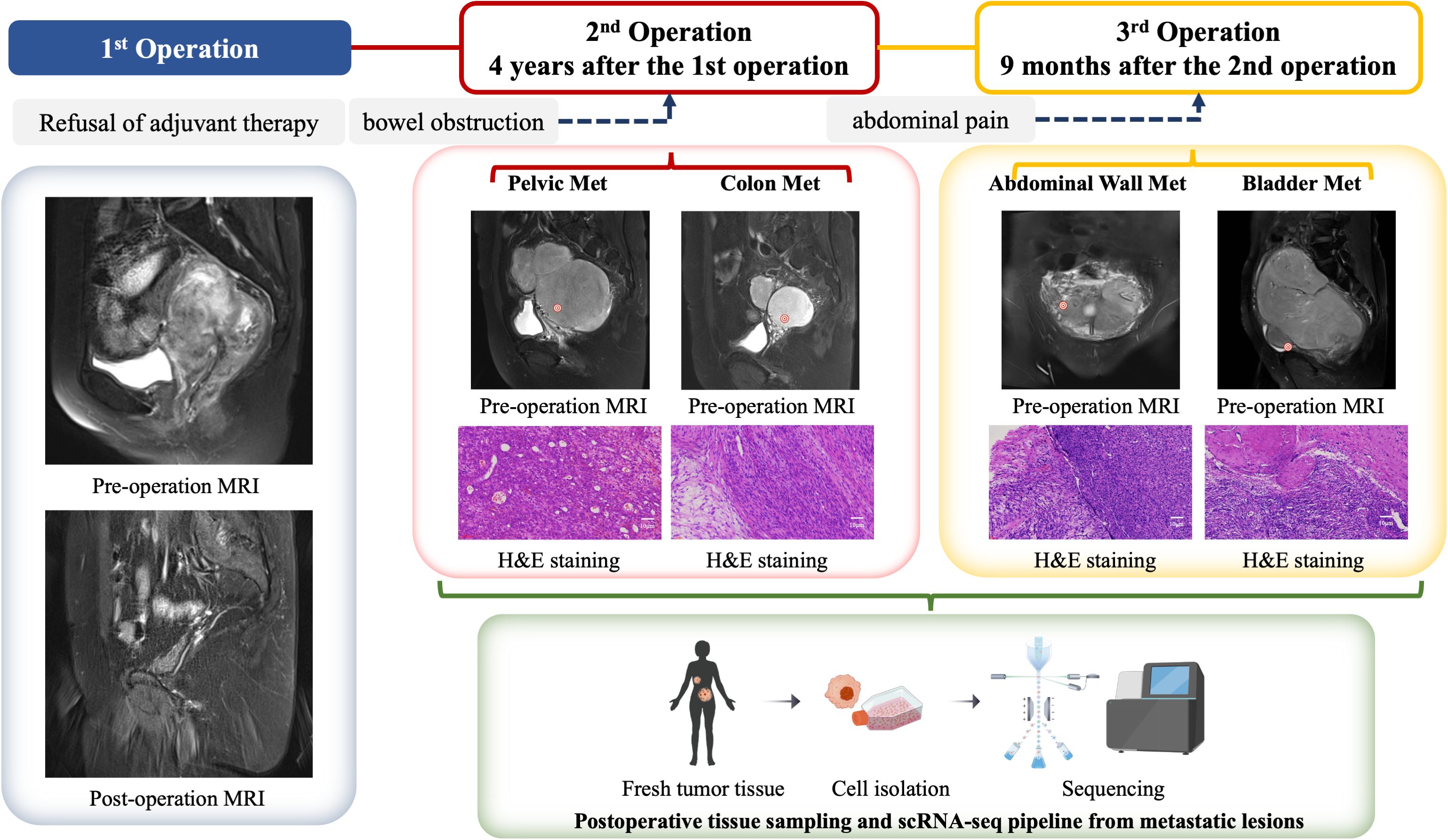 Timeline of three operations with MRI images and H&E staining for different metastases. The first operation shows pre- and post-operation MRIs with refusal of adjuvant therapy. The second operation, four years later, includes pelvic and colon metastases with MRIs and H&E stains. The third operation, nine months after, shows abdominal wall and bladder metastases with MRIs and H&E stains. A diagram below illustrates tissue sampling and sequencing processes for metastatic lesions.