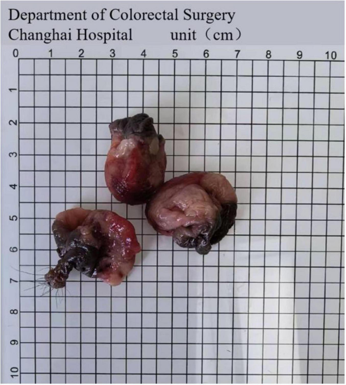 Surgical specimens on a grid from the Department of Colorectal Surgery at Changhai Hospital. The grid has centimeter markings for size reference.