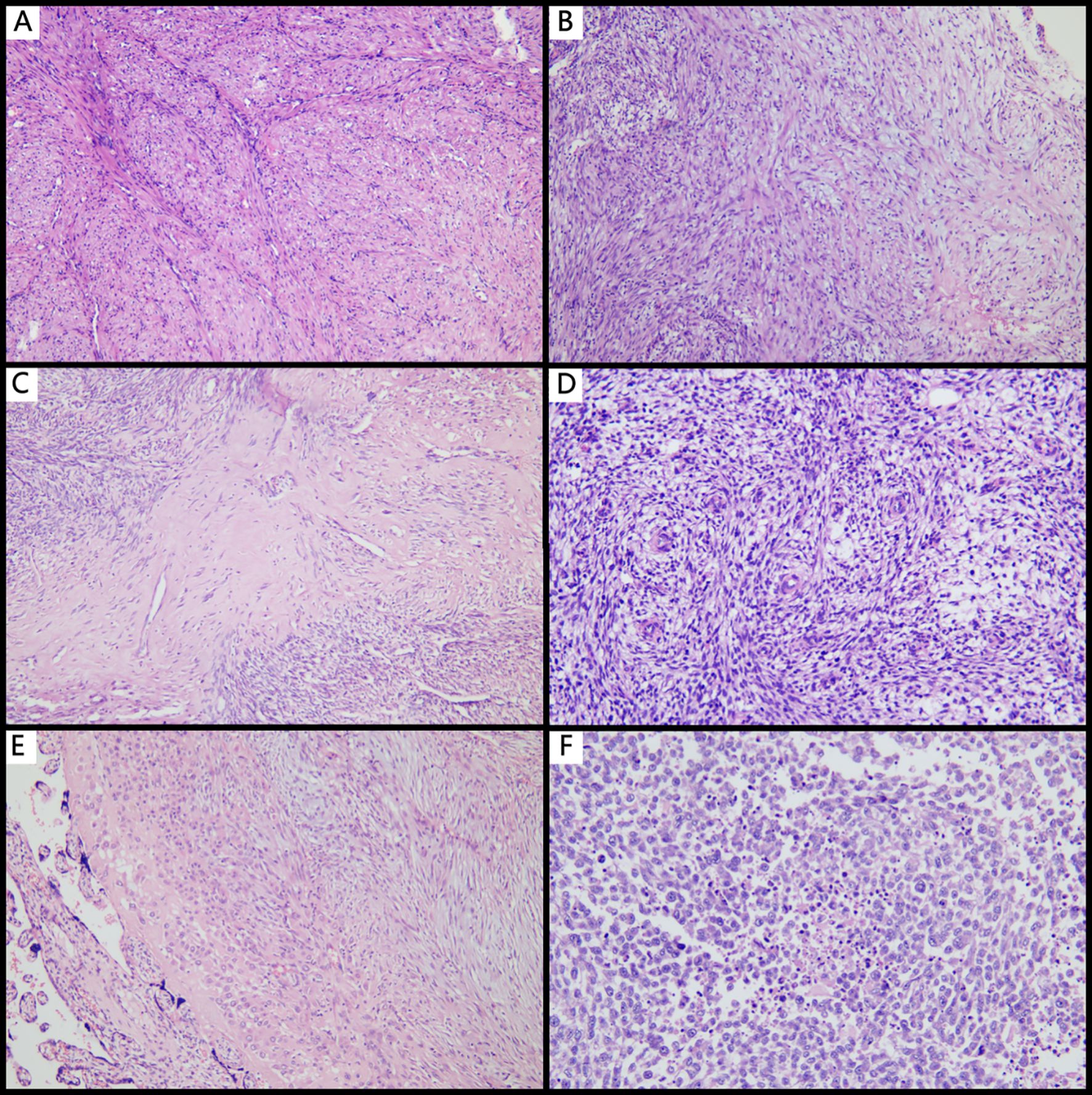 Histological images labeled A to F, displaying various tissue samples under a microscope. Each panel shows a different cellular structure and density, with variations in staining intensity. Panel A and E appear less dense, while panels B, D, and F show a higher concentration of cells. Panel C shows a moderate density with distinct fibrous patterns.